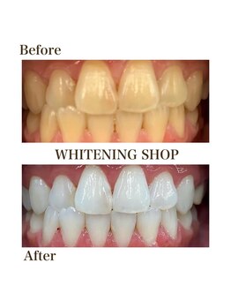 ホワイトニングショップ 大分店/Before&Aftre美白ホワイトニング