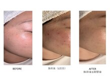 サロン ド ヂュエル(SALON DE JEWEL)の雰囲気（シミケアフェイシャルの経過になります。1回でも薄くなります◎）