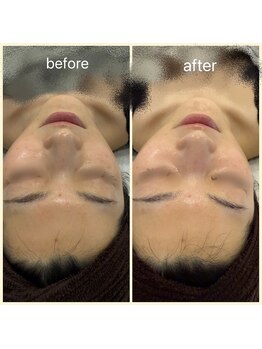 ムーンストーン(Moonstone)/プラピールビフォーアフター