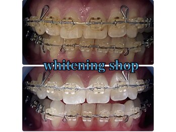 ホワイトニングショップ 鳳店/BeforeAfter 美白ホワイトニング