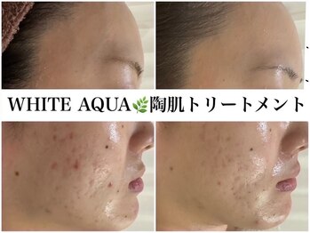 ホワイトアクア 広島店(WHITE AQUA)/ハーブピーリング/ニキビケア