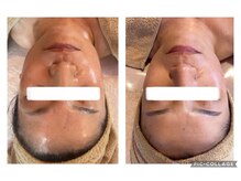 エム(emu)/小顔矯正マッサージ