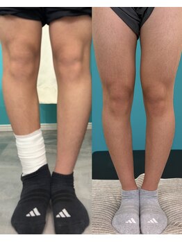 西宮ヤノ整骨院の写真/骨盤姿勢改善でＯ脚Ｘ脚や猫背をケアし、膝の痛みや歩き方、むくみをサポート◎！
