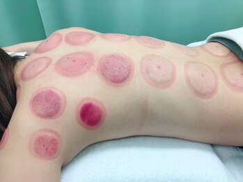 たくみ整体院/【吸い玉】施術における残色色体