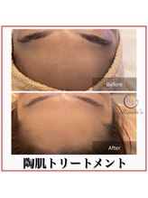 ラナン パラフューズ(Ranun's PARAFUSE.)/陶肌ビフォーアフター（3）