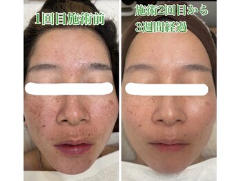 ムー(mu)/ハードハーブピーリング