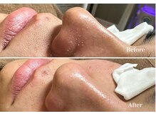 フフラバイプラス(FUFLA BY PLUS)/ハイドラ毛穴洗浄