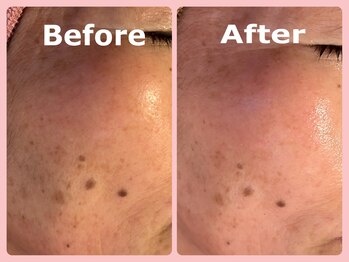 スイ 昭島店(Sui)/ハーブピーリング/シミケア/美白