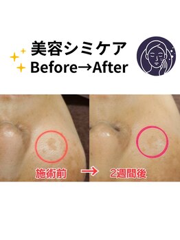 ヒカリ(Hikari)/ビフォーアフター