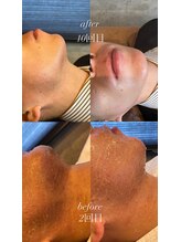 アレーズ(ALAISE)/髭脱毛before & after