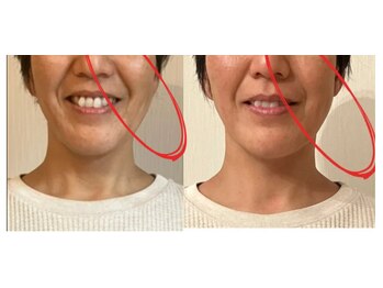 カラダミックス(karadamix)/ほうれい線の改善