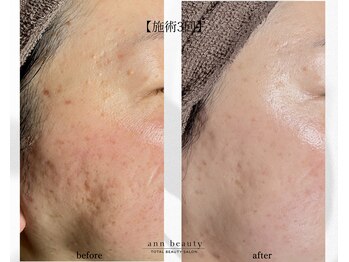 アン ビューティー(ann beauty)/施術3回【症例写真】30代