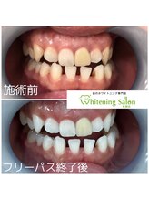 ホワイトニングサロン 札幌店/【ホワイトニング】#札幌#大通り