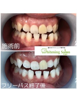 ホワイトニングサロン 札幌店/【ホワイトニング】#札幌#大通り