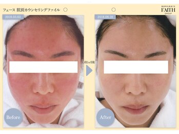 ザ フェース 京都御池店(THE FAITH)/お客様のお肌変化