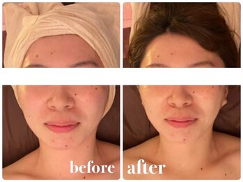 チェリッシュ フェイス 藤沢(CHERISH FACE)/小顔顔筋形成