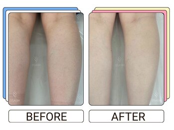 ストラッシュ 心斎橋店(STLASSH)/施術例：ふくらはぎ