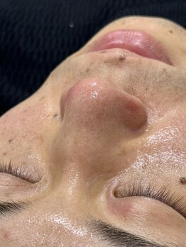 グルーム(GROOM.)の写真/【肌と眉毛をトータルケア】毛穴汚れを大掃除。#毛穴洗浄ハイドロスプラッシュ#眉毛セット