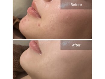 素肌研究所BSラボ/ハーブピーリング【顔】