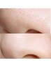 毛穴の引締め、毛穴目立ちが気になる方はコチラ!お顔全体の引締めも叶う