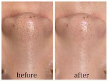 アリエス/ハイドラ×美白フォト１回の変化