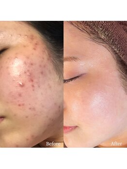 フルール ニコ(Fleur Nico)/8回のBeforeAfter