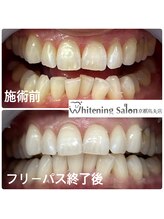 ホワイトニングサロン 京都烏丸店/ホワイトニング瀬術例