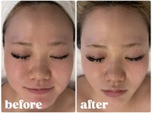 スムース(smooth)/ワイコ水光ピール