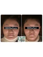 キュープ 小顔美容矯正専門サロン 横浜店(Qpu)/初回での変化