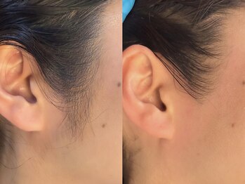 アルク(ARC)/ワックス脱毛/部分ワックス脱毛