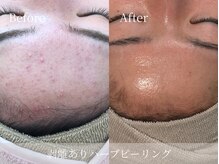 アパラギ(Aparagi)/額ニキビ改善/改善期間3ヶ月