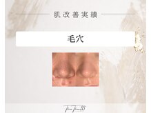スリースリー 恵比寿(THREE THREE)/毛穴ケア 改善実績写真