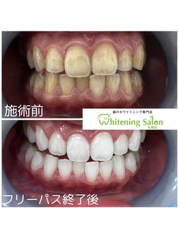 ホワイトニングサロン 札幌店/【ホワイトニング】#札幌#大通り