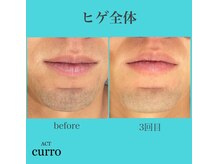 アクト クロ(ACT curro)/【ヒゲ全体】脱毛施術例