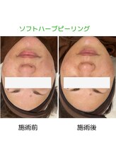 ムー(mu)/ソフトハーブピーリング