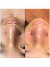 シャラ(shara)/黒ずみポツポツ毛穴洗浄