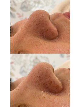 ミント(mint)/#毛穴洗浄 #ハーブピーリング