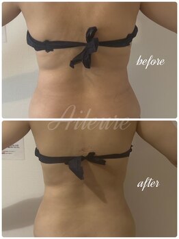 エルール トータルビューティ(Aileure total beauty)/ダウンタイムケアインディバ