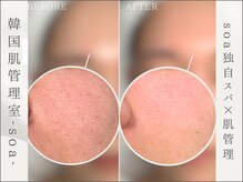 韓国肌管理室 ソア(soa)/【before&after】トロイピール