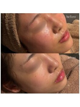 セレア(CELEA)/水光/刺さない針エアダーマ導入