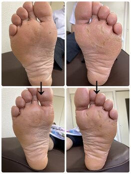 フロー(Froh)/ウオノメ多数