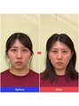 整音(totonone) 食い縛りにより咬筋が筋肥大、食い縛りをとり面長改善