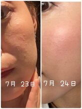 エターナル(Eternal)/ハーブピーリングでつるんと艶肌