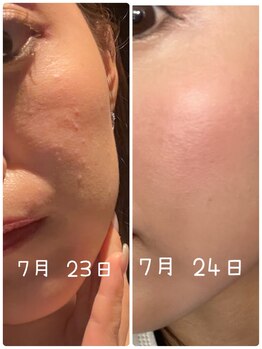 エターナル(Eternal)/ハーブピーリングでつるんと艶肌