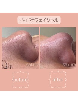 ビューティートータルサロン サクラ 千歳店(SAKURA)/毛穴洗浄☆ハイドロフェイシャル