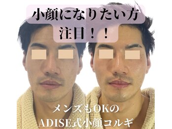 アディス 心斎橋(ADISE)/メンズにも大人気の小顔コルギ！
