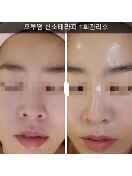 ポピン(POPIN)/O2 to Derm + LED一回での効果