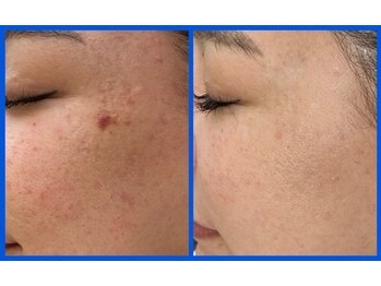 チュルリ 新町店(Chururi)/【肌質改善】自分史上最高美肌へ