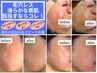 【特典付】何してもダメだった肌悩みにはコレ！【肌プロセル】洗顔８時間不可