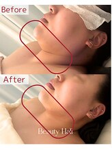 縁(en)/RED SHOT　施術効果